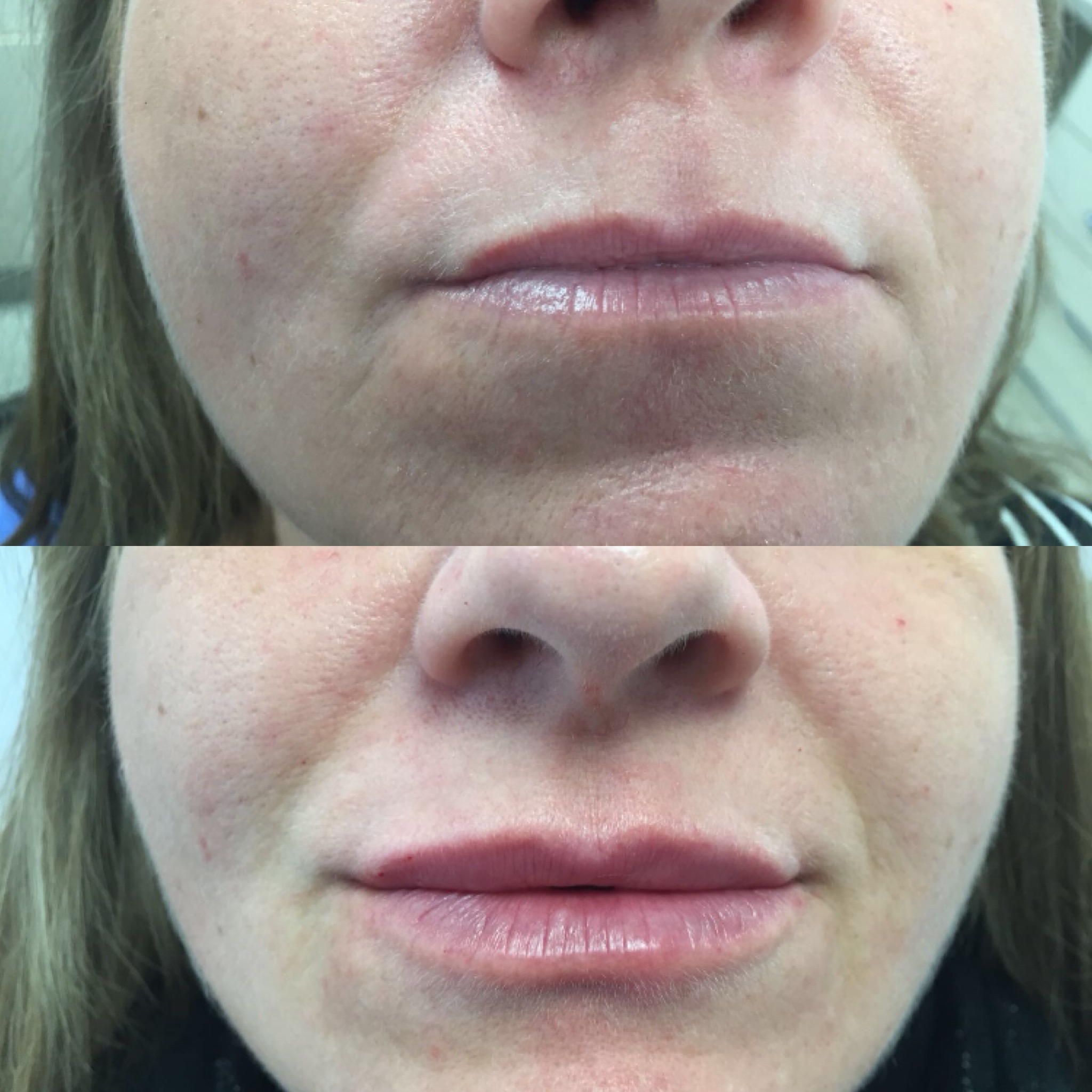 lip filler 3