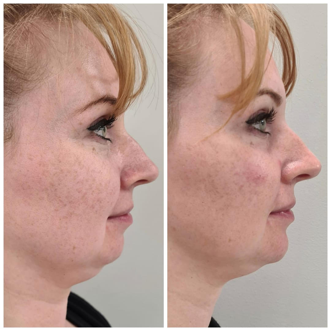filler chin, nose and cheek