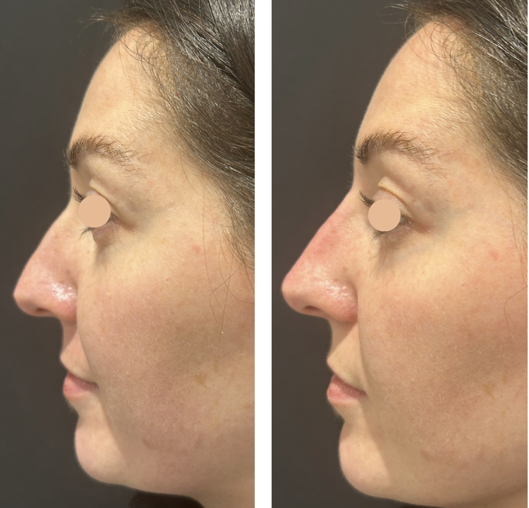 nose filler