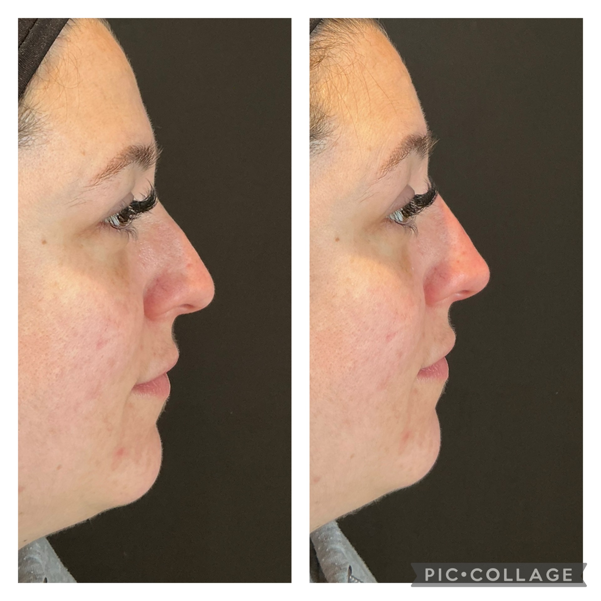 nose filler