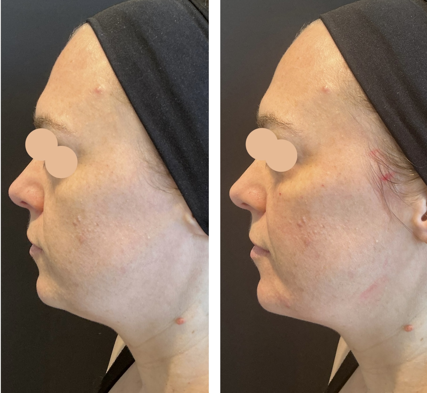 cheek and chin filler