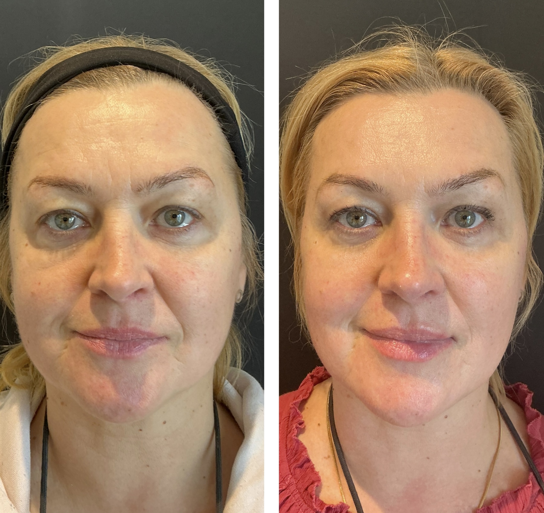 full face rejuvination with diller
