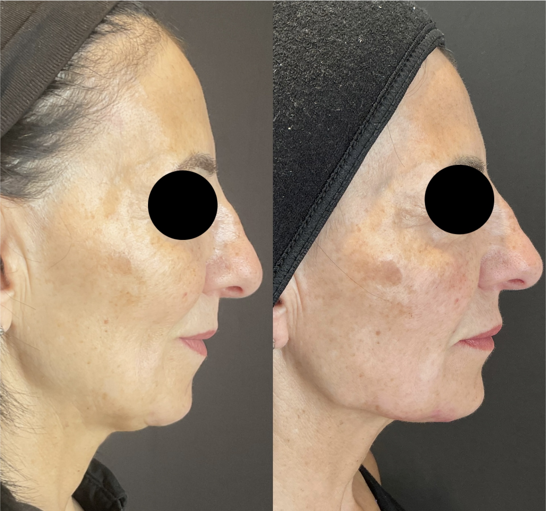 Full face rejuvination with filler